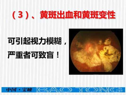 孕期眼睛花,是什么原因,孕期视力模糊怎么回事儿 第2张 孕期眼睛花,是什么原因,孕期视力模糊怎么回事儿 第2张