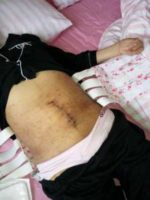 胎儿37周可以剖腹产吗(37周做剖腹产对孩子有影响吗) 第3张 胎儿37周可以剖腹产吗(37周做剖腹产对孩子有影响吗) 第3张