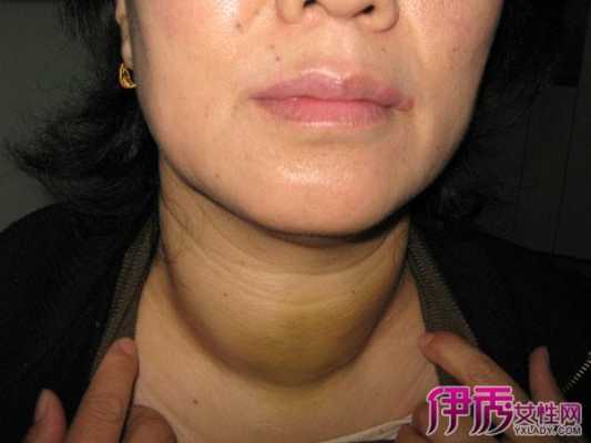 孕期有甲亢(孕妇甲亢有什么症状) 第1张 孕期有甲亢(孕妇甲亢有什么症状) 第1张