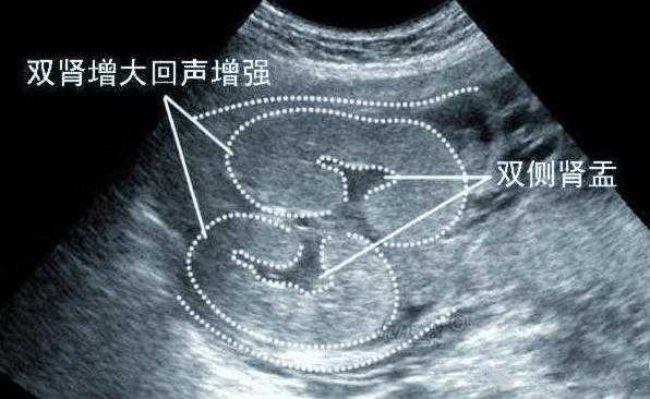 双肾小胎儿(胎儿有两个肾盂有影响吗) 第2张 双肾小胎儿(胎儿有两个肾盂有影响吗) 第2张