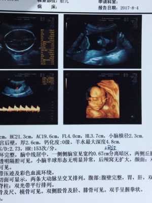 二十四周胎儿(孕24周侧脑室宽度标准) 第2张 二十四周胎儿(孕24周侧脑室宽度标准) 第2张