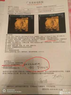 二十四周胎儿(孕24周侧脑室宽度标准) 第1张 二十四周胎儿(孕24周侧脑室宽度标准) 第1张