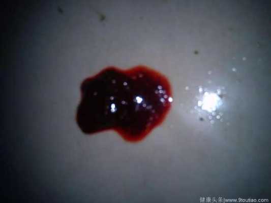 大便出血对胎儿有影响吗(怀孕37周大便带血对胎儿有影响吗) 第2张 大便出血对胎儿有影响吗(怀孕37周大便带血对胎儿有影响吗) 第2张