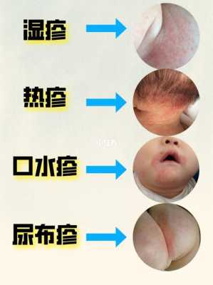 皮肤病会影响胎儿吗(皮肤病会影响胎儿吗) 第2张 皮肤病会影响胎儿吗(皮肤病会影响胎儿吗) 第2张