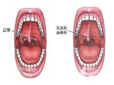 备孕期间扁桃体发炎（备孕期间扁桃体发炎怎么办最简单的方法）  第2张