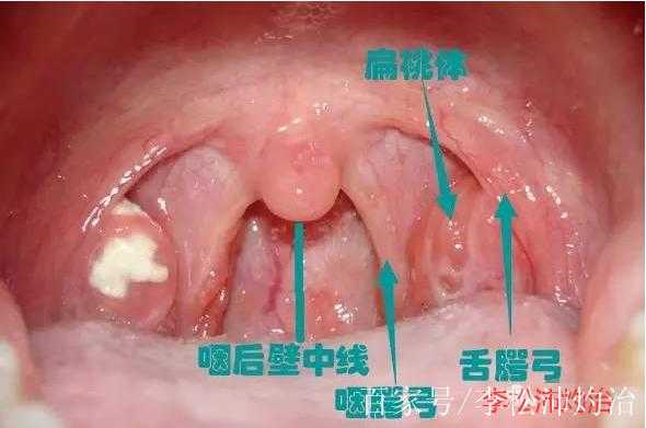 备孕期间扁桃体发炎（备孕期间扁桃体发炎怎么办最简单的方法）  第1张
