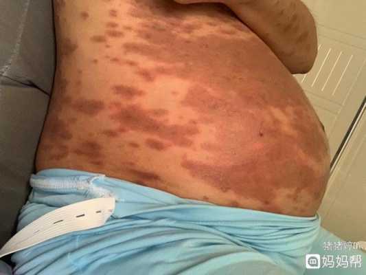 孕期得湿疹（孕期得湿疹会影响胎儿吗）  第3张