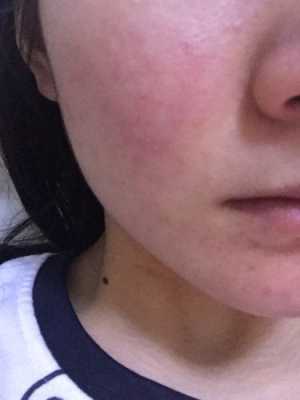 孕期脸干怎么办,孕期脸疼怎么回事 第1张 孕期脸干怎么办,孕期脸疼怎么回事 第1张
