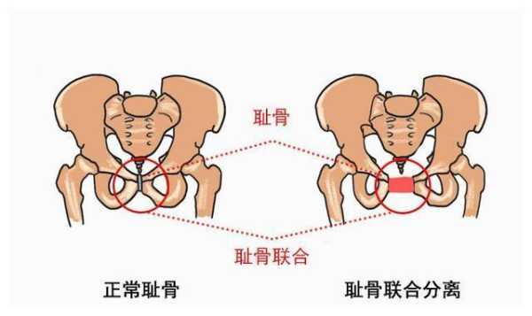 孕期骨盆痛怎么办,孕期骨盆痛位置图 第3张 孕期骨盆痛怎么办,孕期骨盆痛位置图 第3张