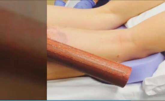怀孕5个月,大腿变粗,走路内侧碰到,摩擦很痛。你们有吗,孕期胖大腿和屁股怎么减 第3张 怀孕5个月,大腿变粗,走路内侧碰到,摩擦很痛。你们有吗,孕期胖大腿和屁股怎么减 第3张