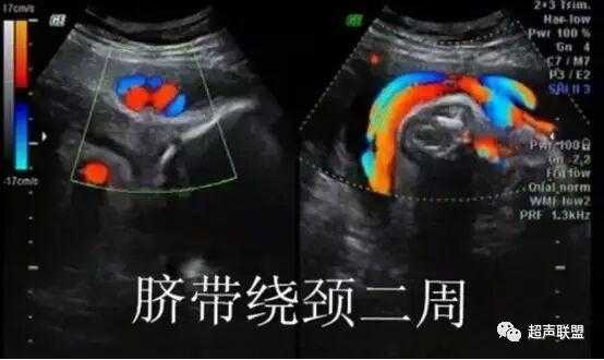 怀孕37周胎儿检查颈项可见u型压迹是什么意思,脐带绕颈要多走路还是多躺 第1张 怀孕37周胎儿检查颈项可见u型压迹是什么意思,脐带绕颈要多走路还是多躺 第1张