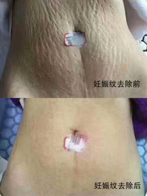 怀孕期间妊娠纹去除(孕妇肚子的妊娠纹怎么消除) 第1张 怀孕期间妊娠纹去除(孕妇肚子的妊娠纹怎么消除) 第1张