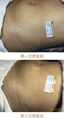 怀孕期间妊娠纹去除(孕妇肚子的妊娠纹怎么消除) 第3张 怀孕期间妊娠纹去除(孕妇肚子的妊娠纹怎么消除) 第3张