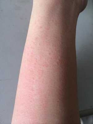 孕期皮肤过敏了怎么办(孕期皮肤过敏了怎么办) 第1张 孕期皮肤过敏了怎么办(孕期皮肤过敏了怎么办) 第1张