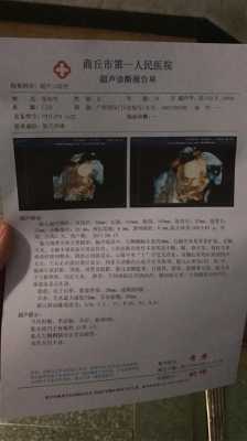 孕27周4天,左侧侧脑室宽约0.7CM,正常吗,胎儿脑室正常值是多少 第1张 孕27周4天,左侧侧脑室宽约0.7CM,正常吗,胎儿脑室正常值是多少 第1张