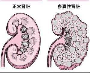胎儿肾发育不良(胎儿肾发育不良的原因分析) 第1张 胎儿肾发育不良(胎儿肾发育不良的原因分析) 第1张