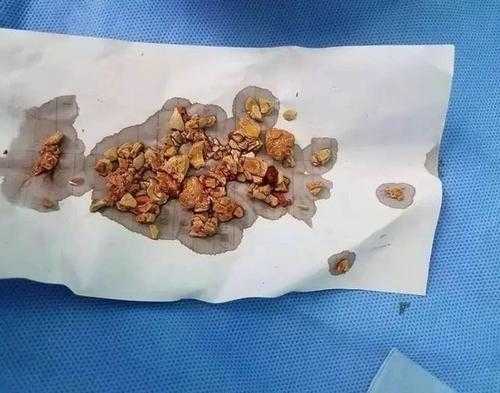 孕期有结石(孕妇有肾结石的问题,不是很严重,怀孕期间能够喝牛奶吗) 第1张 孕期有结石(孕妇有肾结石的问题,不是很严重,怀孕期间能够喝牛奶吗) 第1张