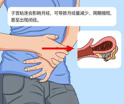 粘连带对胎儿有影响吗(子宫粘连带对胎儿有影响吗) 第1张 粘连带对胎儿有影响吗(子宫粘连带对胎儿有影响吗) 第1张