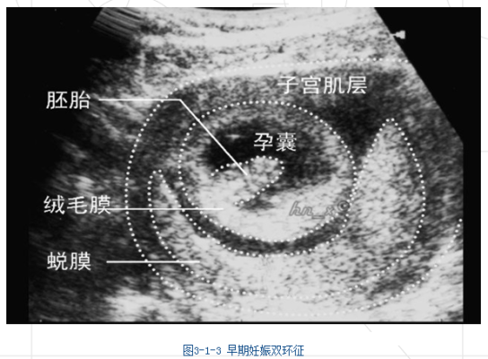胎儿声像图(胎儿声像图是什么意思) 第2张 胎儿声像图(胎儿声像图是什么意思) 第2张