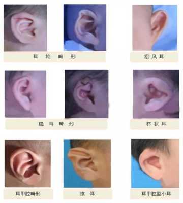 宝宝耳朵怎么会畸形的啊?怀孕期间需要注意哪些呢,吃什么会导致胎儿畸形吗 第2张 宝宝耳朵怎么会畸形的啊?怀孕期间需要注意哪些呢,吃什么会导致胎儿畸形吗 第2张