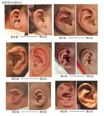 宝宝耳朵怎么会畸形的啊?怀孕期间需要注意哪些呢,吃什么会导致胎儿畸形吗 第1张 宝宝耳朵怎么会畸形的啊?怀孕期间需要注意哪些呢,吃什么会导致胎儿畸形吗 第1张