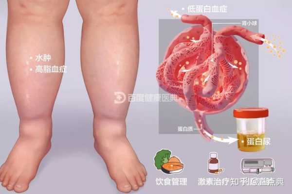 孕期肾病(孕期肾病综合征的临床表现) 第2张 孕期肾病(孕期肾病综合征的临床表现) 第2张