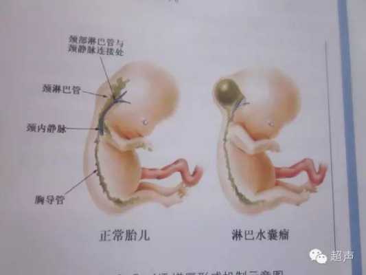 胎儿水肿可以生下来吗(怀孕12周nt12胎儿颈部水囊瘤水肿怎么办) 第1张 胎儿水肿可以生下来吗(怀孕12周nt12胎儿颈部水囊瘤水肿怎么办) 第1张