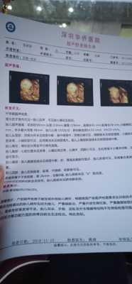23周照四维,检查宝宝左侧脉络丛囊肿对宝宝有影响吗,双侧脉络丛囊肿胎儿能要吗 第2张 23周照四维,检查宝宝左侧脉络丛囊肿对宝宝有影响吗,双侧脉络丛囊肿胎儿能要吗 第2张