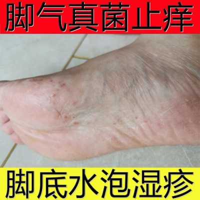 孕期脚湿疹(孕期脚湿疹可以涂什么药膏) 第2张 孕期脚湿疹(孕期脚湿疹可以涂什么药膏) 第2张