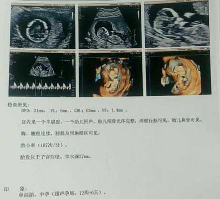 胎儿检查nt(nt检查是什么?孕期做nt检查是检查什么项目呢) 第3张 胎儿检查nt(nt检查是什么?孕期做nt检查是检查什么项目呢) 第3张