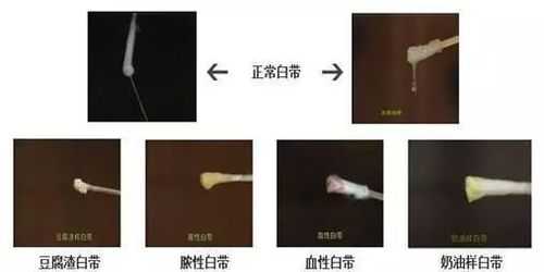 怀孕初期的白带是什么样子,早孕期间白色分泌物 第3张 怀孕初期的白带是什么样子,早孕期间白色分泌物 第3张