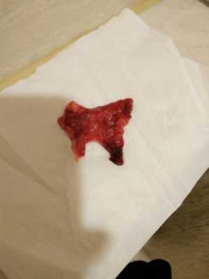 怀孕初期流血为什么会越来越多？孕期流血，胎儿能保住吗,怀孕期流血怎么回事  第2张