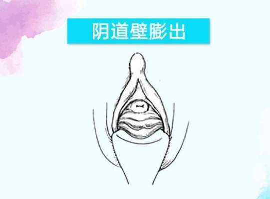 孕期阴道会松弛吗(阴壁膨出1度2度3度图) 第1张 孕期阴道会松弛吗(阴壁膨出1度2度3度图) 第1张