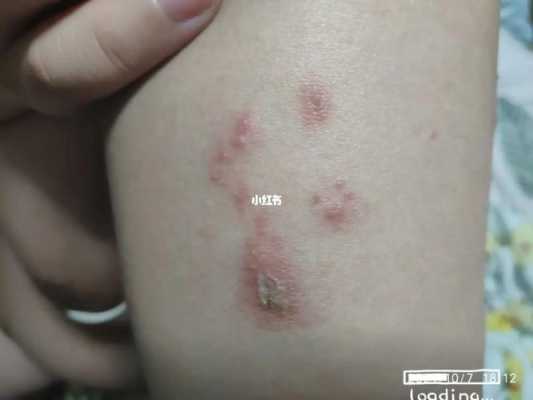 怀孕长疱疹了怎么办,孕期疱疹怎么办才好得快 第2张 怀孕长疱疹了怎么办,孕期疱疹怎么办才好得快 第2张