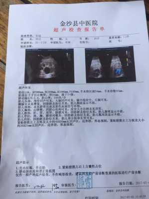 胎儿右侧囊肿(胎儿右侧囊肿是因为什么原因引起的) 第1张 胎儿右侧囊肿(胎儿右侧囊肿是因为什么原因引起的) 第1张