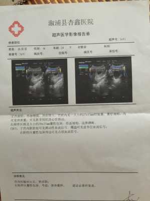 胎儿右侧囊肿(胎儿右侧囊肿是因为什么原因引起的) 第2张 胎儿右侧囊肿(胎儿右侧囊肿是因为什么原因引起的) 第2张