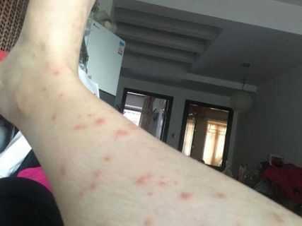 孕妇得湿疹怎么办,孕期丘疹性荨麻疹怎么办 第2张 孕妇得湿疹怎么办,孕期丘疹性荨麻疹怎么办 第2张