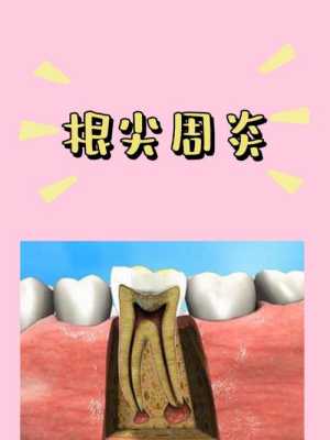 孕期根尖炎(孕期根尖炎疼怎么缓解) 第1张 孕期根尖炎(孕期根尖炎疼怎么缓解) 第1张