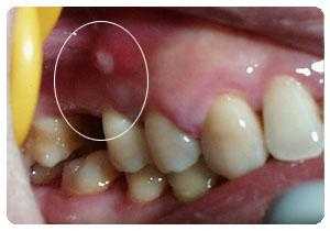 孕期根尖炎(孕期根尖炎疼怎么缓解) 第2张 孕期根尖炎(孕期根尖炎疼怎么缓解) 第2张
