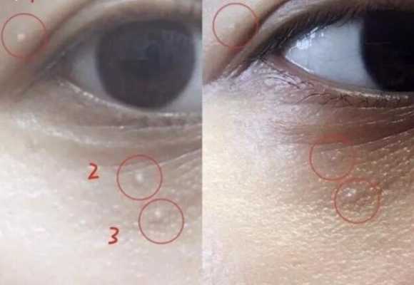 眼睛周围长脂肪粒原因,孕期脂肪粒越来越多 第2张 眼睛周围长脂肪粒原因,孕期脂肪粒越来越多 第2张