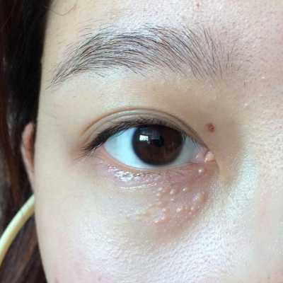 眼睛周围长脂肪粒原因,孕期脂肪粒越来越多 第1张 眼睛周围长脂肪粒原因,孕期脂肪粒越来越多 第1张