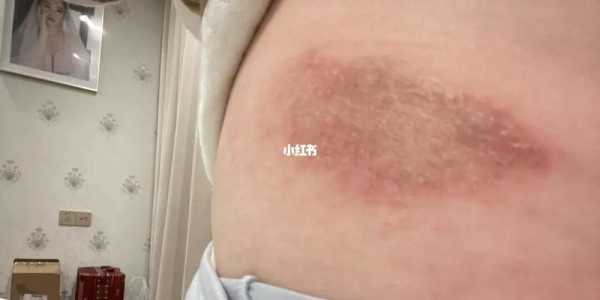 孕妇湿疹会对胎儿有影响吗,怀孕湿疹对胎儿的影响有哪些 第2张 孕妇湿疹会对胎儿有影响吗,怀孕湿疹对胎儿的影响有哪些 第2张