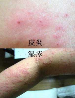 孕妇得湿疹怎么治,怀孕期间起湿疹怎么办 会不会影响宝宝 第2张 孕妇得湿疹怎么治,怀孕期间起湿疹怎么办 会不会影响宝宝 第2张