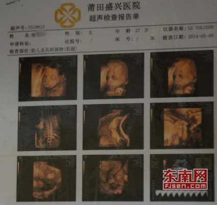 胎儿系统彩色多普勒超声检查是什么意思,胎儿系统b超查什么项目 第1张 胎儿系统彩色多普勒超声检查是什么意思,胎儿系统b超查什么项目 第1张