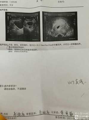 怀孕多少周有胎心,50天没胎心还有希望吗 第2张 怀孕多少周有胎心,50天没胎心还有希望吗 第2张