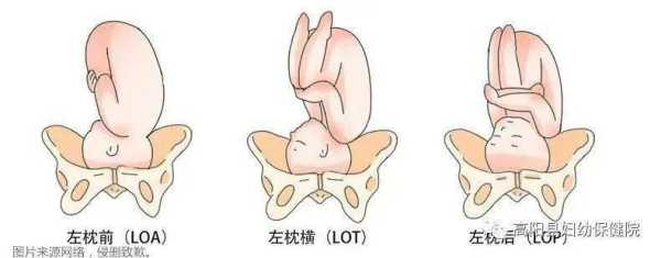 l和p哪个是左,胎儿lop位是什么意思 第1张 l和p哪个是左,胎儿lop位是什么意思 第1张