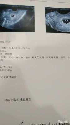 形态不规则有卵黄囊,胎儿不规则什么意思 第2张 形态不规则有卵黄囊,胎儿不规则什么意思 第2张