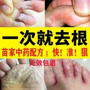 孕妇的脚气怎么治?可以抹什么脚气膏,孕期治脚气的小偏方 第3张 孕妇的脚气怎么治?可以抹什么脚气膏,孕期治脚气的小偏方 第3张