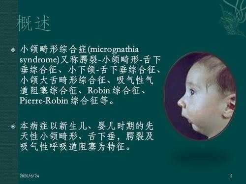 宝宝下颚有点突出怎么办,胎儿下颌小必须引产吗 第2张 宝宝下颚有点突出怎么办,胎儿下颌小必须引产吗 第2张