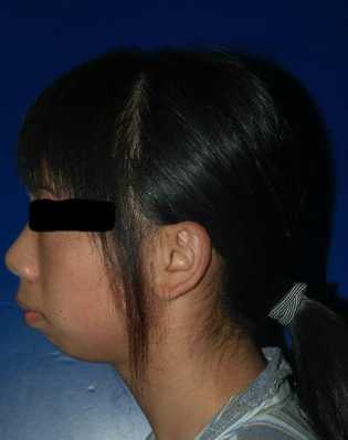 宝宝下颚有点突出怎么办,胎儿下颌小必须引产吗 第1张 宝宝下颚有点突出怎么办,胎儿下颌小必须引产吗 第1张